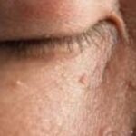Everything You Need to Know About Skin Tag Eyelid Removal