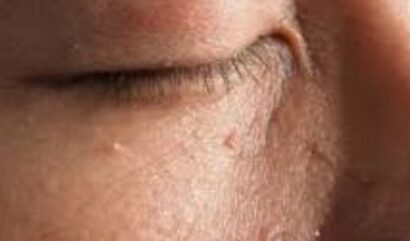 Everything You Need to Know About Skin Tag Eyelid Removal