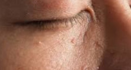 Everything You Need to Know About Skin Tag Eyelid Removal