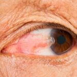 Laser Eye Surgery Cost Guide: What You'll Pay for Vision Correction in the UK